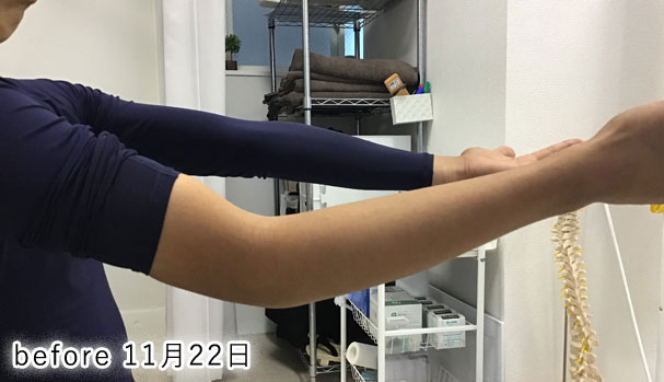 野球肘 施術前1 2019/11/22