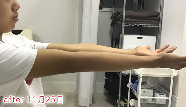 野球肘 施術後1 2019/11/25