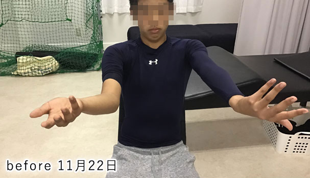 野球肘 施術前2 2019/11/22