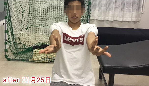 野球肘 施術後2 2019/11/25