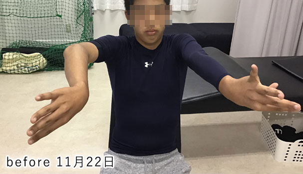 野球肘 施術前3 2019/11/22