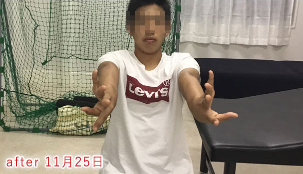 野球肘 施術後3 2019/11/25