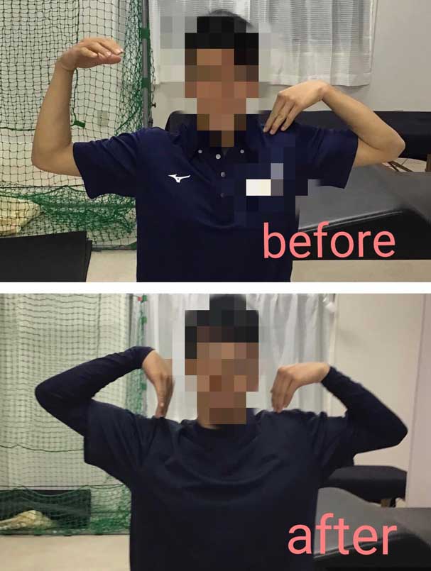 肘が90度しか曲がらなくなった野球肘が改善 イメージ