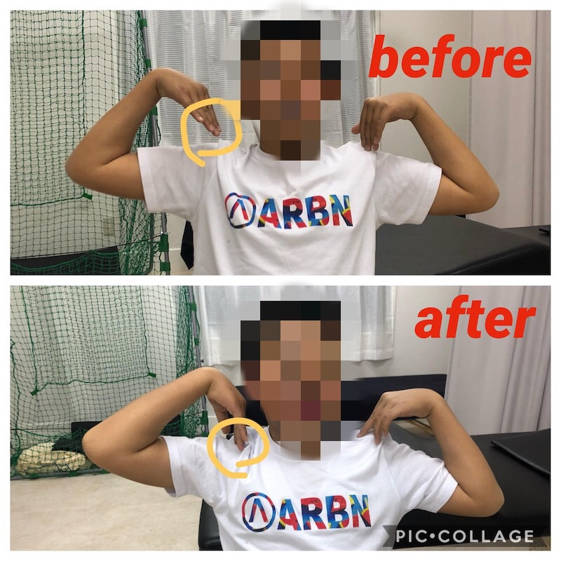 他院で改善しなかった肘が曲がりきらない野球肘が改善！ イメージ