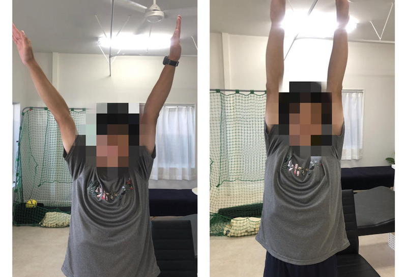 18年間全力投球できなかった肩の痛みが改善 施術前後