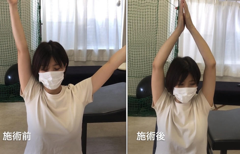 左肩を痛め腕が上がらなくなってしまった方が早期改善 施術前後