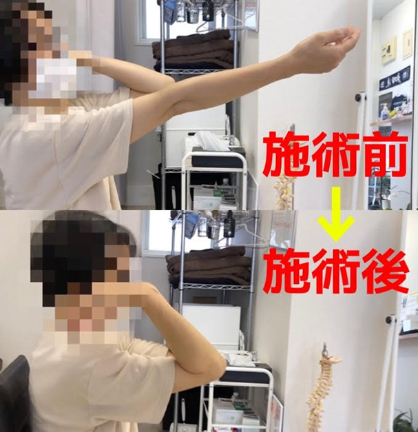 肘の痛みイメージ2