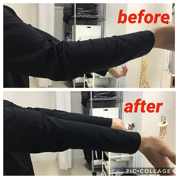 筋トレで肘を痛め、肘が伸びなくなった症状が改善 イメージ